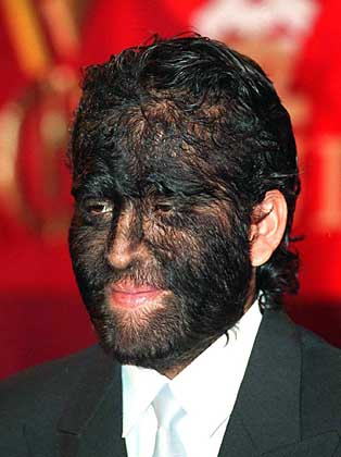 hypertrichosis-fajardo-aceves-jesus-manuel.jpg